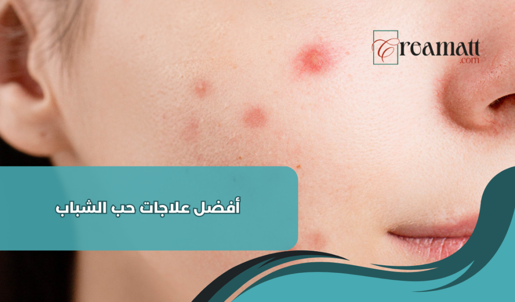 أفضل علاجات حب الشباب