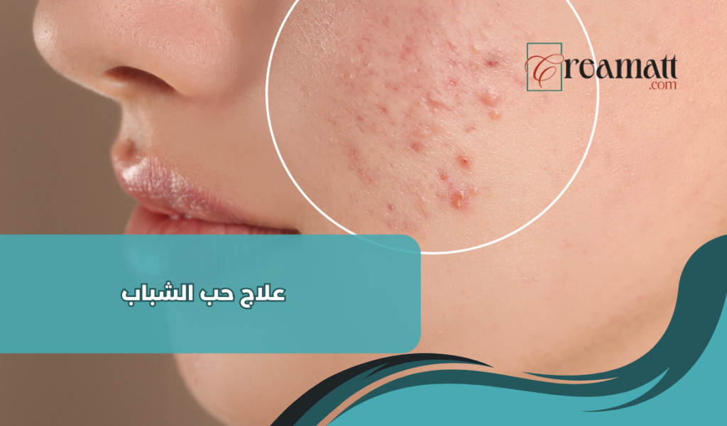 علاج حب الشباب