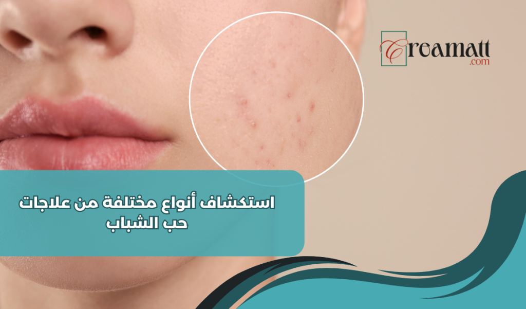 استكشاف أنواع مختلفة من علاجات حب الشباب