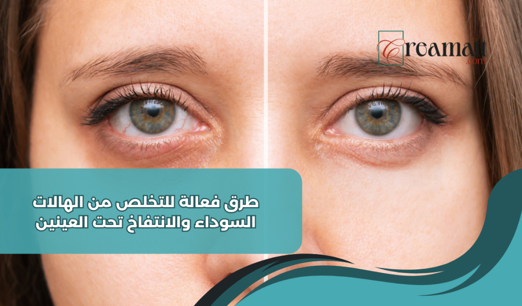 طرق فعالة للتخلص من الهالات السوداء والانتفاخ تحت العينين